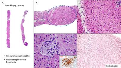 Clinical manifestations and approach to the management of patients with common variable immunodeficiency and liver disease